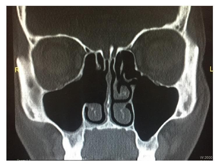 This diagnostic image is a coronal computerized tomography (CT) scan of the paranasal sinuses in bone window. The image demonstrates the postoperative status of the sinonasal cavities following right-sided Functional Endoscopic Sinus Surgery (FESS). Key visual findings include a widely patent right ostiomeatal complex and a right maxillary antrostomy. The right maxillary and ethmoid sinuses are clear and well-aerated, characterized by a lack of opacification, fluid levels, or significant mucosal thickening. Surgical changes on the right side are further evidenced by the absence of the middle turbinate, consistent with a prior middle turbinectomy. In contrast, the left nasal cavity shows intact anatomy, including the left middle and inferior turbinates and a normally aerated left maxillary sinus. The nasal septum is midline, and the orbital structures and skull base appear intact. This image serves as an educational example of a successful surgical outcome in the management of chronic or infectious sinusitis, such as sinonasal actinomycosis, showing complete resolution of previous disease and restoration of normal sinus drainage pathways.
