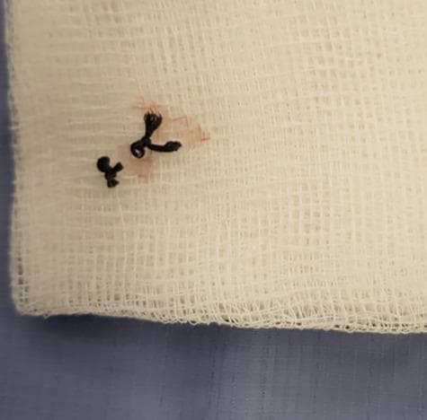 A clinical photograph displaying a retained foreign body removed from a patient. The image shows a dark, likely black, non-absorbable monofilament or braided suture material that has been surgically excised. The suture exhibits two visible surgical knots and is resting on a sterile, white, open-weave gauze dressing. A localized faint reddish-pink serosanguinous stain is visible on the gauze fibers surrounding one of the knots, indicating previous contact with wound tissue or fluid. This visual represents a common complication of post-operative wound healing, specifically a 'suture granuloma' or chronic non-healing wound caused by a retained suture. The image is pedagogically significant for illustrating iatrogenic causes of wound dehiscence or chronic inflammation, highlighting the importance of thorough wound exploration when a patient presents with a persistent, non-healing surgical site.