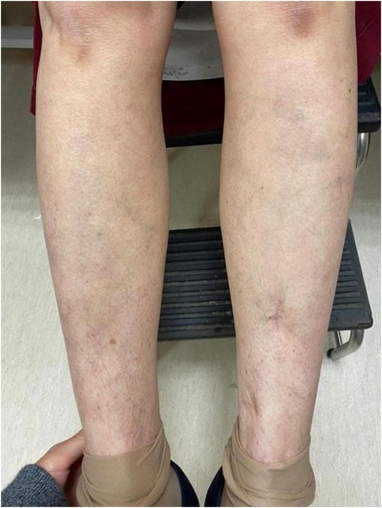 A clinical photograph showing the anterior view of both lower legs of a 62-year-old patient, demonstrating the healing phase of a petechial purpuric rash following 7 days of corticosteroid therapy. The image reveals scattered, fading purplish-red macules and fine petechiae, predominantly distributed on the distal shins and ankles. There is evidence of post-inflammatory hyperpigmentation and subtle residual ecchymosis. Visible vascular markings including superficial veins are apparent. The distribution is roughly symmetrical, showing a marked reduction in lesion density and inflammatory signs compared to an acute purpuric presentation. A small, faint surgical scar is visible on the pretibial area of the right leg. This visual serves to illustrate the clinical progression and therapeutic response of cutaneous vasculitis or a similar systemic inflammatory condition (e.g., associated with elevated rheumatoid factor and ANA) to systemic prednisone.