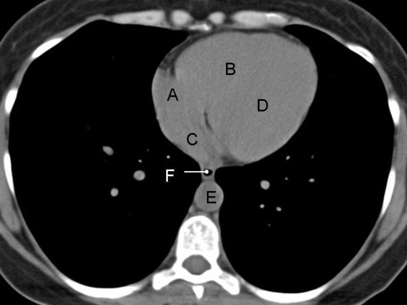 This diagnostic image is an axial non-contrast CT scan of the chest at the level of the heart. The visual highlights the anatomical relationships of cardiac and mediastinal structures labeled A through F. The right atrium (A) is positioned anteriorly and to the patient's right, while the right ventricle (B) occupies the most anterior central position. The left atrium (C) is located posteriorly relative to the right atrium, and the left ventricle (D) is situated posteriorly and to the left of the right ventricle. In the posterior mediastinum, the esophagus (F) is visible as a collapsed structure positioned between the left atrium and the descending thoracic aorta (E), which sits anterior and to the left of the vertebral column. Notably, the lack of intravenous contrast results in uniform soft-tissue attenuation across the cardiac chambers, demonstrating the clinical challenge of delineating the interventricular septum and endocardial borders on non-contrast imaging. This scan serves as an educational reference for normal cross-sectional anatomy and mediastinal spatial orientation.