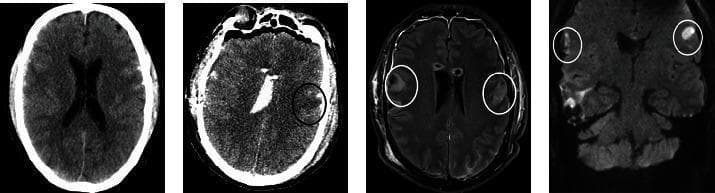 A multi-panel series of neuroimaging studies demonstrating post-traumatic and ischemic brain lesions. Panel (a) is an initial non-contrast axial CT scan showing acute traumatic changes. Panel (b) is a postoperative axial CT scan highlighting a subacute ischemic lesion in the left operculum (black circle) alongside residual post-traumatic changes and generalized cerebral edema. Panel (c) is an axial T2-weighted MRI showing bilateral hyperintense lesions in the opercula (white circles); the right-sided lesion represents parenchymal damage from traumatic contusion, while the left-sided lesion indicates an ischemic event. Panel (d) is a coronal diffusion-weighted image (DWI) confirming restricted diffusion (hyperintensity) within both opercula (white circles). This imaging set illustrates the diagnostic findings for Foix-Chavany-Marie Syndrome (FCMS), characterized by bilateral anterior opercular lesions of mixed traumatic and ischemic etiology.