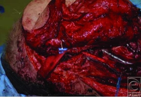This clinical photograph displays an intraoperative view of a complex reconstructive microsurgery procedure in the head and neck region. The surgical field exhibits a near-total thigh free flap being integrated to cover a large cutaneous defect. Central to the image is a flow-through arterial anastomosis, indicated by a white arrow, where a blue microvascular coupler or connector joins the descending branch of the lateral circumflex artery to the facial artery. This specific configuration facilitates a sequential vascular pathway, allowing blood flow to travel through the facial artery into the lateral circumflex system and subsequently to a perforator from the profunda femoris artery. Multiple vascular structures and surgical sutures are visible within the highly vascularized, exposed tissue bed. The image serves as a clinical specimen illustration for plastic and reconstructive surgery, demonstrating advanced microvascular techniques for flap revascularization and the management of multiple independent arterial and venous pedicles.