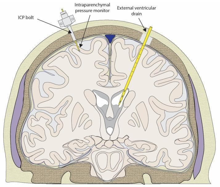This medical diagram illustrates a coronal section of the human head, focusing on neurosurgical instrumentation for Intracranial Pressure (ICP) monitoring. The schematic depicts the skull, cerebral cortex, sulci, and the ventricular system. On the left side of the diagram, an 'ICP bolt' and 'intraparenchymal pressure monitor' are shown. The device is secured through the skull, with a sensor probe extending into the brain tissue (parenchyma) to monitor local tissue pressure. On the right side, an 'external ventricular drain' (EVD) is illustrated. This catheter is inserted through a burr hole in the skull, traversing the parenchyma to reach the lateral ventricle, allowing for both pressure measurement and drainage of cerebrospinal fluid (CSF). The diagram serves as an educational tool for neurotrauma management, demonstrating the anatomical placement and differences between parenchymal and ventricular monitoring systems in clinical settings such as traumatic brain injury.