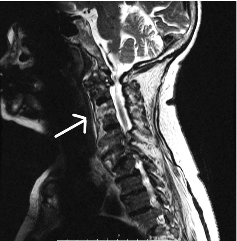 This diagnostic image is a sagittal T2-weighted MRI of the cervical spine illustrating a case of vertebral osteomyelitis and spondylodiscitis spanning from the C5 to C7 levels. The primary findings include abnormally high signal intensity (hyperintensity) within the C5, C6, and C7 vertebral bodies, characteristic of bone marrow edema and infection. The intervertebral discs at these levels demonstrate loss of normal architecture and altered signal intensity, confirming disc involvement (spondylodiscitis). A white arrow highlights the region where cortical endplate irregularities and blurring are most prominent. The prevertebral space anterior to these segments shows increased thickness and signal changes, suggesting associated inflammatory phlegmon or soft tissue edema. The spinal cord is visible posteriorly; while structurally intact, it shows mild signs of extrinsic compression secondary to the vertebral inflammation. This image serves as a clinical example of hematogenous spinal infection, in this instance related to Rat-bite fever (Streptobacillus moniliformis), emphasizing the radiological features of infectious spinal processes in an adult patient.
