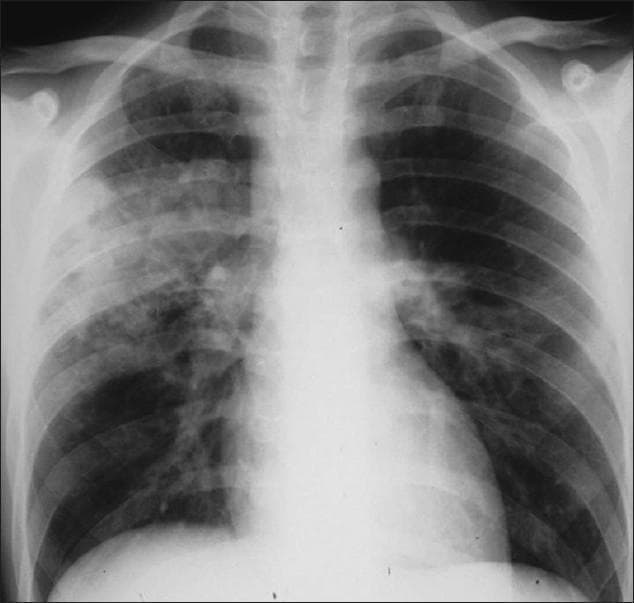 This diagnostic image is a posteroanterior (PA) chest X-ray demonstrating features consistent with primary Mycobacterium tuberculosis in an immunocompromised patient. The radiograph reveals focal areas of dense opacification, specifically consolidation in the right upper lobe and the left midzone. These opacities appear as increased white density that obscures the underlying pulmonary vasculature. In addition to parenchymal disease, there is evidence of mediastinal adenopathy, characterized by widening and contour abnormality of the hilar and paratracheal regions. Notably, despite the significant consolidation, there is a total lack of cavitation (hollowing out of the lung tissue), which is a common radiographic feature of primary TB in patients with low CD4 counts. The pleural spaces appear clear with no visible pleural effusions or pneumothorax. The image illustrates the atypical presentation of tuberculosis often seen in advanced HIV/AIDS, where lymphatic involvement and absence of cavitation are prominent features.