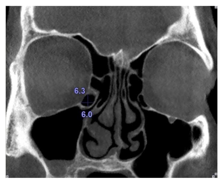 This diagnostic image is a coronal computed tomography (CT) scan of the paranasal sinuses focusing on the osteomeatal complex. The scan reveals a clear view of the nasal cavity divided by the nasal septum, flanked by bilateral air-filled maxillary sinuses and ethmoid air cells. Centrally, the inferior and middle nasal turbinates are visible. An anatomical variant known as a Haller cell (infraorbital ethmoid cell) is identified on the patient's right side (visualized on the left side of the image), located along the medial orbital floor and the superior-lateral aspect of the maxillary sinus ostium. Blue annotations and a crosshair indicate quantitative measurements of this Haller cell, with a vertical dimension of 6.3 mm and a horizontal dimension of 6.0 mm. The image serves as an educational example of sinonasal anatomy and anatomical variations that can contribute to the narrowing of the infundibulum and potential predisposition to recurrent sinusitis. The clinical focus is on preoperative mapping and diagnostic radiology in otolaryngology.