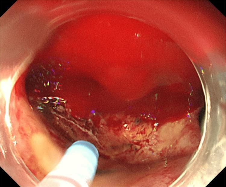 This clinical photograph shows a high-definition endoscopic view of the duodenal bulb during an upper gastrointestinal endoscopy. The primary finding is a deep, excavated peptic ulcer with a heterogeneous base containing whitish-yellow fibrin and areas of darker, necrotic tissue or adherent clot. The lumen is extensively occupied by fresh, bright red blood (hematinic fluid), indicating severe active hemorrhage. The blood is seen pooling and obscuring much of the surrounding mucosal architecture. In the bottom left foreground, a blue-tipped endoscopic instrument is visible, indicating an active attempt at hemostasis or assessment. The visual findings are consistent with a high-risk Forrest classification (likely FIa or FIb) ulcer, where the brisk rate of bleeding suggests arterial involvement. This image is used to teach endoscopic recognition of life-threatening gastrointestinal bleeding and the challenges of visualizing a source in a field filled with fresh blood.