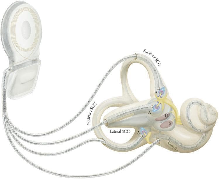 A medical anatomical diagram illustrating a vestibulocochlear implant system integrated with the human inner ear labyrinth. The visual highlights the relationship between the external processor/internal receiver unit and the terminal electrode arrays. The inner ear structures are clearly labeled, showing the three semicircular canals (Superior, Posterior, and Lateral SCC) in their orthogonal orientation, alongside the utricle (U) and saccule (S) within the vestibule. Each semicircular canal is depicted with an electrode lead entering through a bony fenestration to reach the ampulla (A), where it targets the terminal afferent nerve fibers of the crista ampullaris. A separate cochlear lead is shown entering the base of the cochlea. This illustration demonstrates the surgical placement and anatomical targets of vestibular implants designed to restore balance by electrically stimulating the vestibular system's sensory organs.