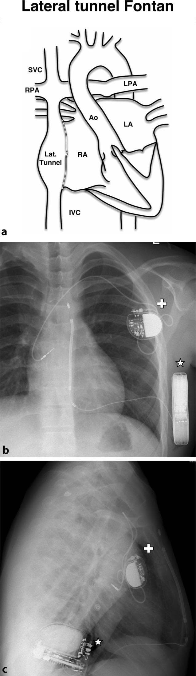 This composite educational resource illustrates a hybrid cardiac device management strategy in a patient with a lateral tunnel Fontan procedure for congenital heart disease.
Panel (a) is an anatomical diagram showing the Fontan circulation, highlighting the lateral tunnel connecting the inferior vena cava (IVC) to the pulmonary arteries, bypassing the right heart.
Panels (b) and (c) are posteroanterior and lateral chest radiographs demonstrating the dual-device configuration. A single-chamber transvenous atrial pacemaker (marked with a white cross) is situated in the upper right chest. Its radiopaque lead is seen extending into the systemic venous portion of the right atrium to provide bradycardia support.
Simultaneously, a subcutaneous implantable cardioverter-defibrillator (S-ICD, marked with a white star) is positioned laterally along the ribcage in the PA view and anteriorly in the lateral view. The S-ICD provides defibrillation capabilities without requiring intracardiac leads, which is advantageous in complex post-surgical congenital heart anatomy where venous access to the ventricles may be limited or contraindicated. This case illustrates the integration of transvenous pacing and subcutaneous defibrillation technologies.