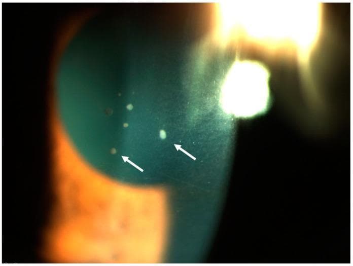 A close-up clinical photograph of the anterior segment of a human eye using slit-lamp biomicroscopy. The image demonstrates active acute granulomatous anterior uveitis. Key findings include multiple keratic precipitates (KPs) on the posterior corneal surface (retrodescemetic area), indicated by white arrows. These precipitates vary in morphology from small granular spots to larger, more opaque deposits. The distribution is localized across the lower portion of the corneal endothelium, which is characteristic of inflammatory cellular accumulation in the anterior chamber. The visual evidence of these 'mutton-fat' style precipitates serves as a hallmark for granulomatous inflammation, often associated with systemic conditions such as sarcoidosis or tuberculosis. The image also displays typical slit-lamp lighting effects, including corneal reflections and a visible beam showing the depth of the anterior chamber.