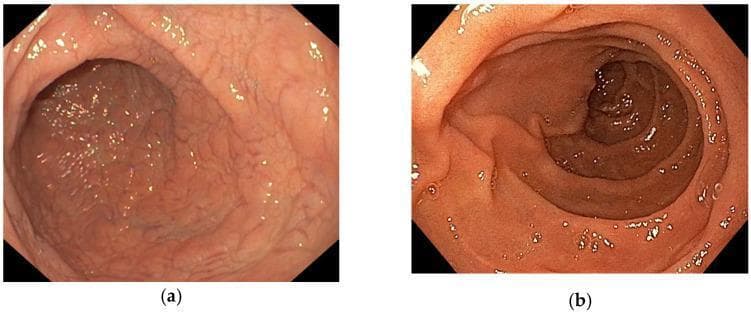 This comparison chart features two endoscopic images of the second duodenum, illustrating the diagnostic visual markers for Celiac Disease (CD). Image (a) depicts the duodenal mucosa of a patient with biopsy-confirmed CD (Marsh 3), showing characteristic villous atrophy. Visually, the mucosa exhibits a flattened, featureless, or 'mosaic' appearance with a notable loss of Kerckring folds (circular folds) and a smoother, more glistening texture compared to healthy tissue. The intestinal lumen appears more tubular and open due to this atrophy. In contrast, image (b) shows a control patient with normal mucosal architecture. It displays prominent, well-defined circular folds and a granular surface texture indicative of healthy villi. The vascular pattern is more intricately visible, and the lumen appears more structured and partially obscured by the physiological folding. These images serve as educational examples for gastroenterology, highlighting the endoscopic features used to identify malabsorptive pathologies in the upper gastrointestinal tract.