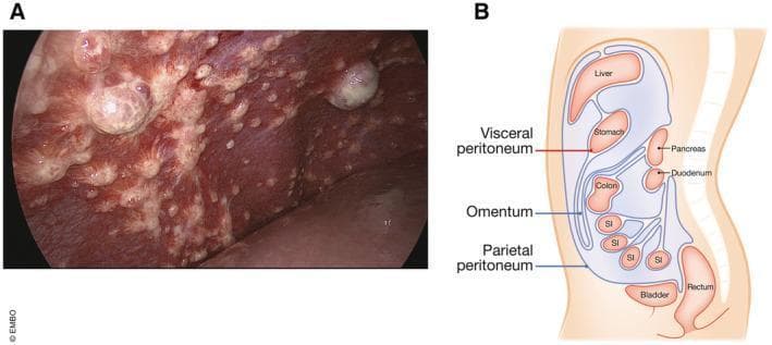 Educational composite image illustrating peritoneal anatomy and metastatic disease. Panel A is a clinical laparoscopic photograph of diaphragmatic peritoneal metastases originating from colorectal cancer. It shows numerous pearly-white, multifocal, nodular lesions of varying sizes (miliary to larger bulbous masses) scattered across the erythematous, vascularized peritoneal surface. Panel B is a medical diagram showing a sagittal view of the abdominal cavity, detailing the anatomical relationship between the parietal peritoneum (lining the abdominal wall and diaphragm) and the visceral peritoneum (enveloping the organs). Labeled structures include the liver, stomach, pancreas, duodenum, colon, small intestine (SI), rectum, bladder, and the omentum—the largest peritoneal fold. This visual comparison aids in understanding the dissemination of gastrointestinal malignancies within the peritoneal space, emphasizing the transition from normal serous membrane anatomy to advanced metastatic disease.