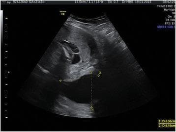 This diagnostic ultrasound image demonstrates a sagittal view of the uterine cervix in a patient at 21 3/7 weeks of gestation. The image displays a long but significantly dilated cervical canal, characterized by the presence of 'funneling' where the internal os is open. Crucially, the ultrasound reveals bulging fetal membranes (amniotic sac) protruding through the cervical opening and into the area of an Arabin pessary, which is visible as a distinct echogenic structure positioned around the cervix. Calipers on the image measure the dimensions of the cervical opening and the extent of the bulging membranes, indicating cervical insufficiency. The amniotic fluid within the protruding sac appears anechoic (black). This visual is representative of a high-risk obstetric scenario involving threatened second-trimester miscarriage or preterm labor, highlighting the sonographic monitoring of cervical changes and the mechanical limitations of a pessary in the presence of advanced cervical dilation.