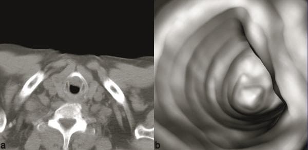 This composite diagnostic image features an axial computed tomography (CT) scan (left) and a corresponding reformatted virtual endoscopy (right) demonstrating severe tracheal stenosis secondary to thyroid cancer invasion. The axial CT at the level of the neck shows significant parenchymal irregularity and asymmetrical enlargement of the right thyroid lobe. There is clear evidence of the thyroid mass eroding the right lateral tracheal wall and extending intraluminally, causing a high-grade reduction in the airway diameter. The virtual endoscopy provides a 3-dimensional perspective of the same region, highlighting the eccentric nature of the tracheal narrowing. This volume-rendered view allows for the assessment of the intraluminal surface and the longitudinal extent of the stricture, which is critical for surgical planning. The educational focus is on the integration of 2D cross-sectional imaging with 3D reconstructive techniques to evaluate airway patency and tissue invasion in thoracic and head-and-neck oncology.