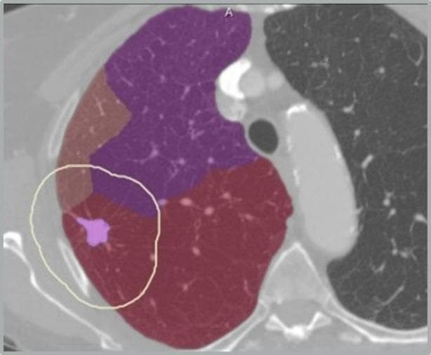This diagnostic image features an axial computed tomography (CT) scan of the thorax with semi-automated segmentation overlays for surgical planning. The scan displays cross-sectional lung anatomy with bronchopulmonary segments differentiated by color coding: purple for the superior region, brown for the lateral aspect, and red for the inferior portion of the visible lung field. A localized light-purple mass, identifying a pulmonary tumor, is located within the red-colored segment. The tumor is encapsulated by a thin, light-yellow or white boundary line, which represents a calculated safety margin for resection. The caption indicates a specific distance of 2 mm between the tumor and the segment border. This visual assessment is used for infiltration risk assessment and to determine the feasibility of segmentectomy versus lobectomy. The background shows standard grayscale CT data of the contralateral lung and mediastinal structures, providing anatomical context for the computer-assisted segmentation results.