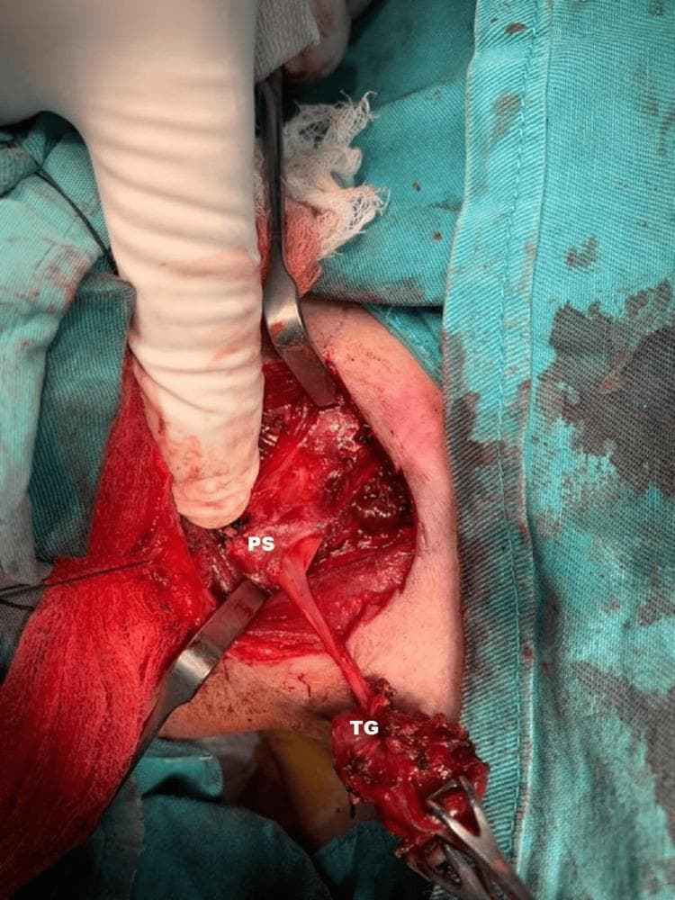 This clinical photograph provides an intraoperative view of the surgical excision of a branchial fistula tract in the right neck. The operative field is exposed through a surgical incision, with drapes and retractors maintaining visibility. A gloved finger and surgical forceps are seen manipulating the tissues. Two key structures are labeled: 'TG' (Thyroid Gland) and 'PS' (Pyriform Sinus). A distinct, elongated, fibrous fistula tract is clearly visible, extending from the superior pole of the right thyroid gland toward the right pyriform sinus. The thyroid tissue appears hemorrhagic and partially dissected, reflecting the surgical manipulation required to isolate the tract. The image illustrates the complex anatomical relationship between the branchial fistula and adjacent endocrine and pharyngeal structures, specifically highlighting the pathway where a fourth branchial pouch sinus typically traverses. This material is educationally relevant for otorhinolaryngology and endocrine surgery trainees to understand the surgical anatomy of congenital neck fistulas.