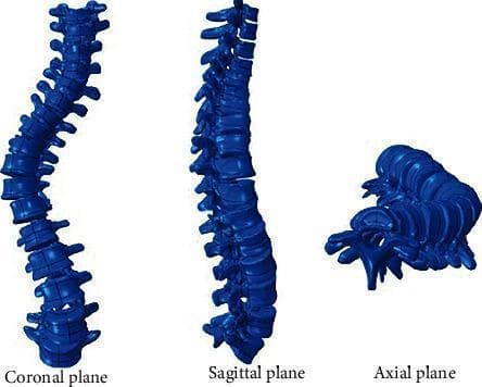 This medical illustration presents a three-dimensional anatomical diagram of the human spine demonstrating scoliosis across three standard orthogonal planes: coronal, sagittal, and axial. In the coronal plane, the spine shows a significant lateral 'S-shaped' curvature, deviating from the normal vertical midline. The sagittal plane view displays the anterior-posterior profile, illustrating alterations in the natural thoracic kyphosis and lumbar lordosis associated with the deformity. The axial plane view highlights the critical rotational component of scoliosis, where vertebral bodies and spinous processes are twisted relative to the longitudinal axis. This visualization serves as an educational tool for orthopedic and radiological study, emphasizing that scoliosis is a complex 3D deformity involving lateral displacement, rotation, and sagittal plane changes. The blue-colored 3D model facilitates the identification of vertebral alignment and the morphological changes used to calculate the Cobb angle for determining clinical severity.