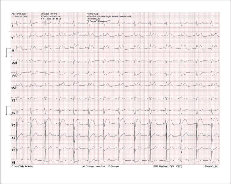 A 12-lead diagnostic electrocardiogram (ECG) demonstrating signs of an acute ST-segment elevation myocardial infarction (STEMI) involving the inferior wall. The tracing shows marked convex ST-segment elevation in the inferior leads (II, III, and aVF), with the most prominent elevation in lead III. Reciprocal ST-segment depression is clearly visible in the lateral limb leads I and aVL. The precordial leads (V1-V6) show relatively normal R-wave progression and stable ST segments, though lead V2 displays a terminal R' wave indicative of an incomplete right bundle branch block (ICRBBB). Digital metadata indicates a QRS duration of 98 ms, a QTc of 435 ms, and a normal cardiac axis. This tracing is a classic educational example of inferior wall ischemia and injury, often associated with occlusion of the right coronary artery, and highlights the clinical importance of identifying reciprocal changes in the high lateral leads.