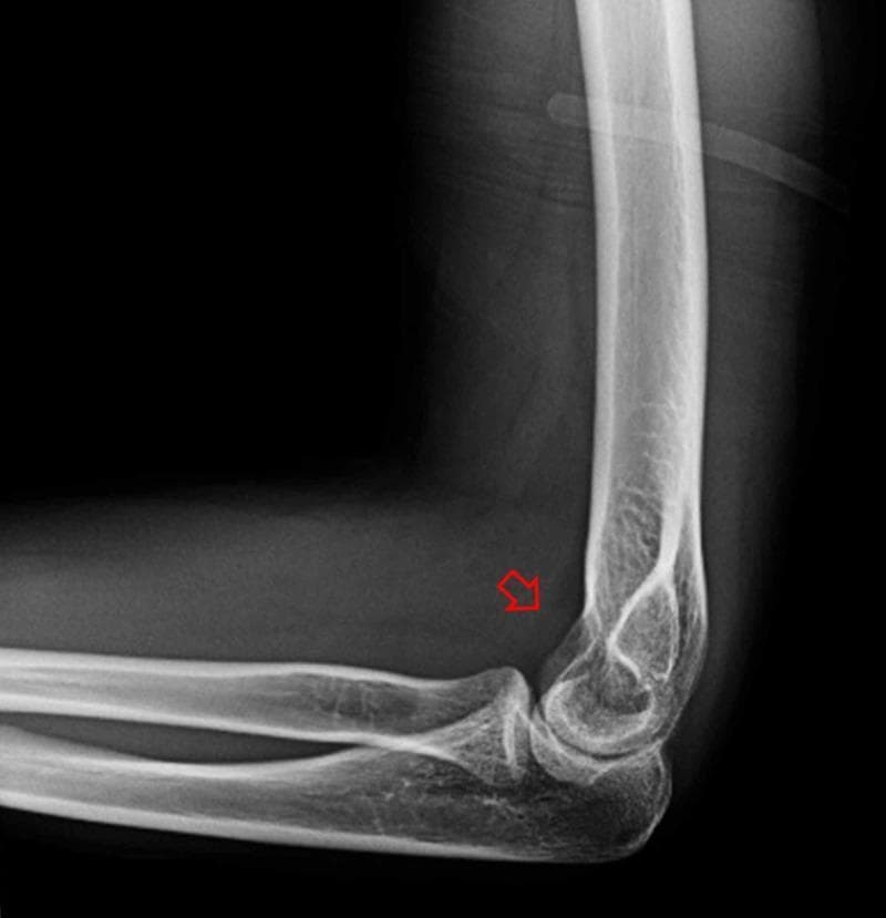 This diagnostic image is a lateral X-ray of a human elbow joint following procedural reduction of a radial head dislocation and elbow subluxation. The radiograph demonstrates restored anatomical alignment: the radial head is congruent with the humeral capitellum, and the ulnohumeral articulation appears well-positioned. No obvious cortical fractures or avulsion fragments are visible in the distal humerus, proximal radius, or ulna. A red arrow points to a subtle, localized area of increased radiopacity within the anterior joint space, suggestive of joint effusion or hemarthrosis. This finding is characterized by a density that is higher than the surrounding soft tissue but significantly lower than the adjacent cortical bone. The image serves as an educational example of post-reduction radiological assessment in emergency orthopedics, highlighting successful joint realignment and secondary signs of intra-articular trauma such as hemarthrosis.