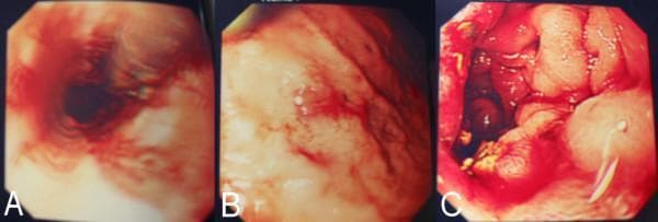 This set of three endoscopic images (A, B, and C) illustrates severe gastrointestinal manifestations of systemic vasculitis, specifically granulomatosis with polyangiitis (Wegener's). Panel A displays an esophageal view characterized by circumferential erythema, mucosal friability, and active longitudinal erosions. Panel B focuses on the gastric mucosa, showing diffuse, patchy inflammation with focal areas of hemorrhage and superficial ulcerations. Panel C provides a view of the duodenum, demonstrating significant mucosal edema and structural distortion. The duodenal surface exhibits intense confluent erythema, scattered petechiae, and adherent fibrinous exudates or sloughing tissue, particularly visible in the foreground. Collectively, these diagnostic images represent systemic inflammatory involvement of the upper gastrointestinal tract, leading to diffuse esophagitis, gastritis, and duodenitis. These findings are clinically significant as rare but severe complications of ANCA-associated vasculitis, highlighting the risk of mucosal ischemia and gastrointestinal hemorrhage.