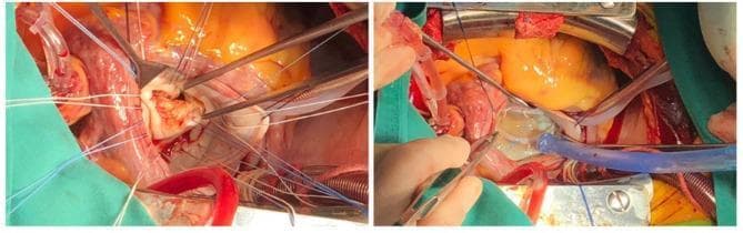 A two-panel clinical photograph illustrating a modified release technique for rheumatic mitral stenosis valvuloplasty (MVP) within an intraoperative cardiac surgical field. The left panel (pre-MVP) shows the mitral valve accessed through a trans-septal approach. The valve leaflets exhibit classic rheumatic features: significant thickening, fibrous contracture, and visible calcification, leading to a restricted orifice and compromised coaptation. The right panel (post-MVP) demonstrates the results of the surgical intervention, which includes commissurotomy and leaflet thinning. The repaired leaflets show physiological bulging and an improved coaptation area, as visualized during an intraoperative water test. An annuloplasty ring is visible, providing structural support to the valve apparatus. Surrounding both panels is a standard surgical field containing retractors, cannulas for cardiopulmonary bypass, and various stay sutures used to expose the left atrium and valve commissures. This comparison highlights the transition from a stenotic, calcified rheumatic valve to a functional, pliable configuration following surgical reconstruction.