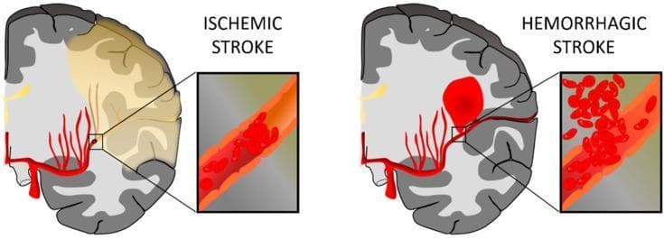 This medical illustration presents a side-by-side comparison of the two primary types of cerebrovascular accidents: Ischemic Stroke and Hemorrhagic Stroke. The diagram uses a coronal cross-section of the human brain and magnified insets to demonstrate the underlying pathophysiology. On the left, 'Ischemic Stroke' is depicted by a large yellowish-tan region in the cerebral cortex, representing infarcted tissue resulting from hypoperfusion. The inset reveals an intraluminal thrombus (blood clot) obstructing an artery, preventing distal blood flow. On the right, 'Hemorrhagic Stroke' is characterized by a focal, bright red intraparenchymal hematoma. The corresponding inset shows a ruptured vessel with erythrocytes extravasating into the surrounding brain tissue. Both illustrations highlight the middle cerebral artery territory. This anatomical diagram serves as an educational tool to differentiate between occlusive and hemorrhagic mechanisms of brain injury, emphasizing the clinical significance of vascular integrity and patency in maintaining cerebral blood flow.