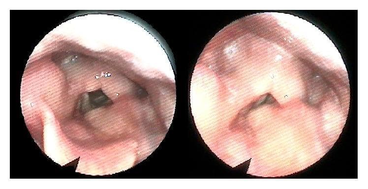 Two circular panels show a diagnostic endoscopy of the human larynx, specifically a postoperative view following surgical repair of laryngeal trauma. The clinical photographs depict the internal laryngeal anatomy, including the epiglottis, false vocal folds, and true vocal cords. The mucosal surfaces appear pinkish-red and healthy, with no visible signs of acute inflammation, significant granulation tissue, or ulceration. The true vocal folds are centrally positioned and form a dark triangular glottic opening, suggesting patency of the airway. The left panel shows the larynx in a more open (abducted) state, while the right panel shows a slightly different phase of mobilization or viewing angle. The anatomical structures, including the arytenoids and surrounding vestibular folds, appear symmetrical and well-defined. This endoscopic evaluation is used to assess postoperative healing, laryngeal lumen patency, and vocal cord mobility after complex laryngeal reconstruction, such as thyroid and cricoid cartilage fracture repair.