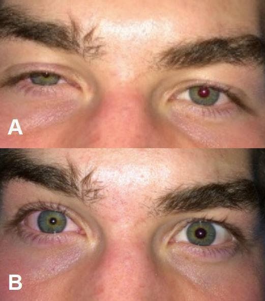 Two-panel clinical photograph (labeled A and B) demonstrating unilateral Horner's syndrome of the right eye following a nerve block procedure. Image A shows classic signs including significant ptosis (drooping of the upper eyelid), miosis (constriction of the pupil), and conjunctival injection (redness) of the right eye compared to the normal left eye. Image B captures the same patient with a higher upper eyelid position and larger pupil diameter in the right eye, illustrating the transition or comparison of clinical findings. The image serves as a teaching tool for recognizing the sympathetic nerve fiber disruption triad, typically presenting as ptosis, miosis, and anhidrosis. This specific case highlights iatrogenic Horner's syndrome as a potential complication of anesthesia/regional blocks involving the cervical plexus or stellate ganglion.