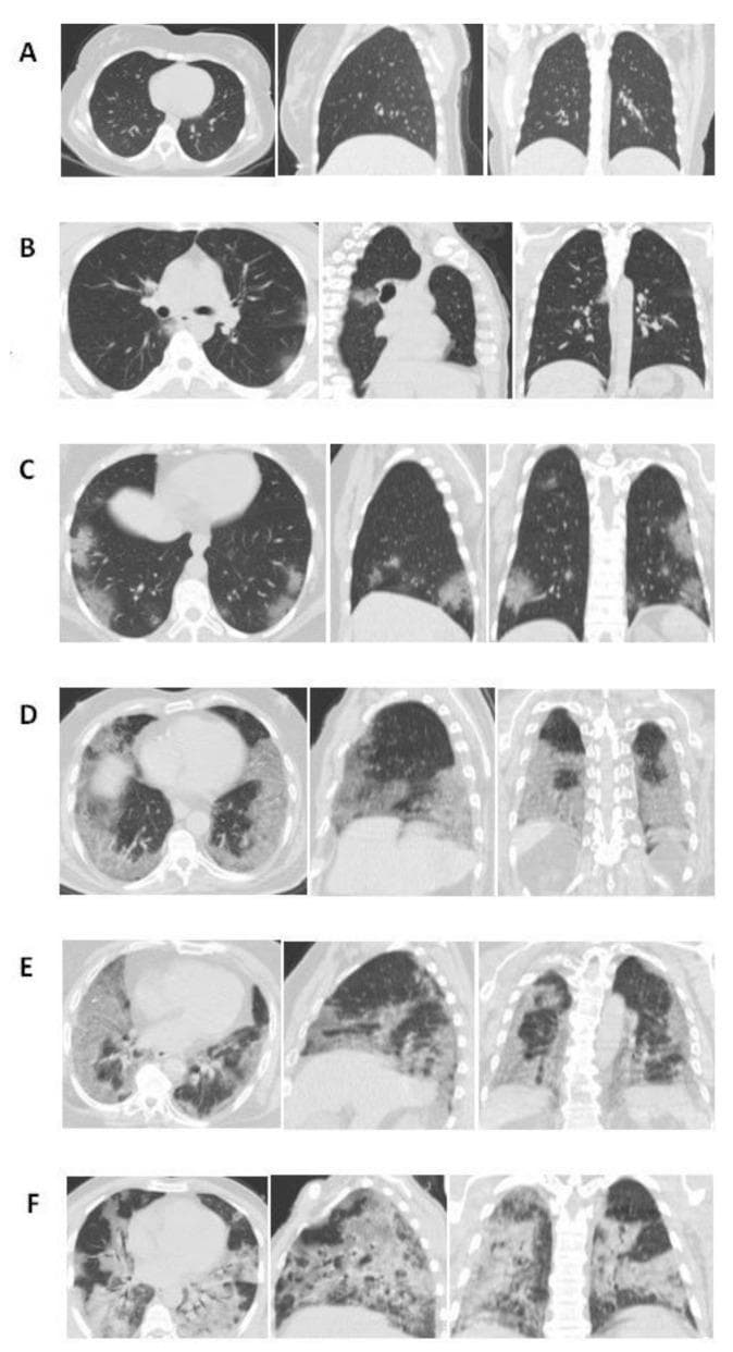 This chest CT compilation illustrates a semi-quantitative severity scoring system for lung involvement, typically applied in the context of viral pneumonia such as COVID-19. The image presents eighteen panels organized into six rows (A-F), showing axial, sagittal, and coronal planes for each severity score level (0 to 5).
(A) Score 0: Normal lung parenchyma with no visible abnormalities.
(B) Score 1: Less than 5% involvement, showing isolated, faint ground-glass opacities (GGOs).
(C) Score 2: 5–25% involvement, with multi-focal GGOs appearing more distinct in peripheral zones.
(D) Score 3: 26–49% involvement, demonstrating extensive GGOs and early consolidative patches distributed across middle and lower zones.
(E) Score 4: 50–75% involvement, showing dense, confluent consolidations and GGOs involving the majority of the lung volume.
(F) Score 5: Over 75% involvement, characterized by diffuse, high-density consolidation and parenchymal architectural distortion across all lobes.
This progression visualizes the transition from focal ground-glass density to widespread consolidation, serving as a radiological reference for disease staging and severity assessment.