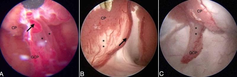This set of intraoperative endoscopic images illustrates variations in the neuroanatomical fixation of the choroid plexus (CP) within the lateral ventricles across three clinical scenarios (A, B, and C). The images highlight the relationship between the glomus of the choroid plexus (GCP), the tela choroidea, and the associated vasculature. In Panel A, a large choroidal artery is marked by a black arrow within a defined GCP, while the tela choroidea (asterisks) is visible as a translucent, sheet-like membrane. Panel B shows a case of agenesis of the septum pellucidum, where the CP is clearly separated from the choroidal artery by a thin, vascularized tela choroidea. Panel C demonstrates a variant with significant elongation of the GCP, appearing as a vertical, band-like structure separated from the main CP body. These images serve as an educational resource for neurosurgeons to identify anatomic variations in GCP mobility and tela choroidea density during endoscopic third ventriculostomy (ETV) or choroid plexus cauterization (CPC).