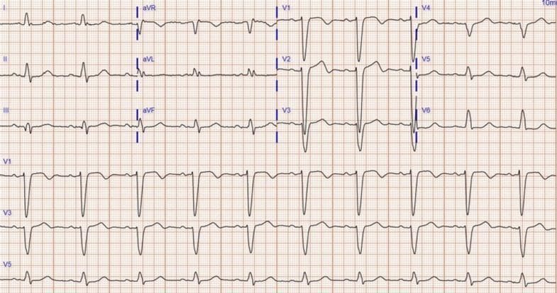 This diagnostic image is a 12-lead electrocardiogram (ECG) demonstrating classic features of a Left Bundle Branch Block (LBBB). The tracing shows a wide QRS complex (168 ms) with a predominantly negative QS morphology in the right precordial leads (V1-V3) and broad, monophasic R-waves in the lateral leads (I, aVL, V5, and V6). The QRS complexes exhibit characteristic slurring and notching, particularly evident in lead V1. Secondary ST-T wave abnormalities are present, including ST-segment depression and T-wave inversion in the lateral leads (V5-V6), which are discordant to the QRS direction. Additionally, the tracing displays significant QTc prolongation (567 ms). This ECG serves as a clinical archetype for diagnosing ventricular conduction delays and is relevant for cardiology students and clinicians managing patients with heart failure or those undergoing cardiac resynchronization therapy.