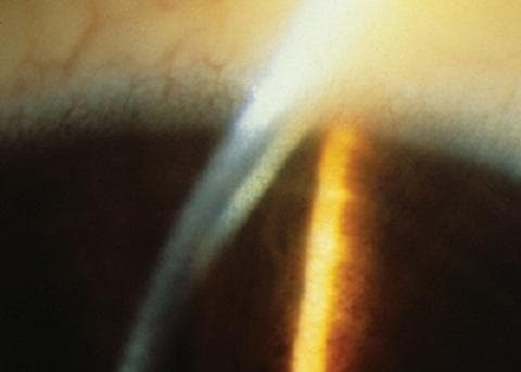 This clinical photograph shows a close-up slit-lamp examination of the eye, specifically focusing on the anterior segment and cornea. A prominent Kayser-Fleischer ring is visible as a golden-brown or greenish-yellow circumferential band located at the corneal periphery. This pigment deposition occurs within Descemet's membrane near the limbus. The slit-lamp beam provides cross-sectional illumination, highlighting the depth of the copper deposition and the relative transparency of the central corneal stroma. Subtle limbal vascularization is observed in the peripheral sclera. This finding is a pathognomonic sign of Wilson's disease (hepatolenticular degeneration), reflecting systemic copper overload and abnormal metabolism of ceruloplasmin. The image serves as a high-yield diagnostic reference for ophthalmology and internal medicine, illustrating the classic ocular manifestation of this metabolic disorder.