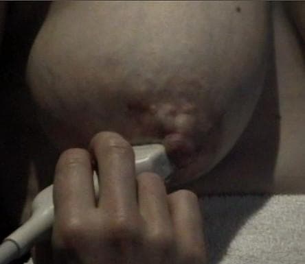 This clinical photograph displays a right lactating breast during the milk ejection reflex, alongside the application of a diagnostic ultrasound probe. The areola demonstrates significant physiological swelling and increased tension, resulting in a full, convex appearance. This visual change is indicative of the expansion of superficial milk ducts as oxytocin-induced myoepithelial contraction forces milk from the alveoli into the ductal system. A linear ultrasound transducer is positioned in direct contact with the inferior portion of the areola, stabilized by a hand to monitor ductal dilation and milk flow in real-time. The skin surface shows slight lobulation or prominence corresponding to the underlying distended ducts. This image illustrates the physical manifestations of the milk ejection reflex and the non-invasive clinical method of using ultrasound to study lactation physiology and breastfeeding dynamics.