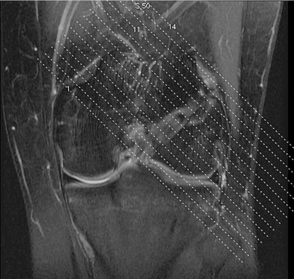 This diagnostic image is a T2-weighted sagittal MRI scan of a human knee joint, captured six months post-Anterior Cruciate Ligament (ACL) reconstruction. The image provides a detailed view of the femoral condyles, the tibial plateau, and the joint space with visible articular cartilage layers. A primary focus is the femoral bone tunnel and the reconstructed ACL graft, which are being assessed for postoperative outcomes. Superimposed on the anatomical scan is a grid of numbered, diagonal white dotted lines (ranging from labels 5.50 to 14). These lines represent the planning of cross-sectional scan layers, oriented perpendicular to the long axis of the femoral bone tunnel. This specialized imaging plane is used for the precise measurement of bone tunnel enlargement and to evaluate the integration of the graft. The image demonstrates key concepts in orthopedic radiology, including postoperative graft assessment, tunnel positioning, and MRI slice acquisition planning for musculoskeletal analysis.