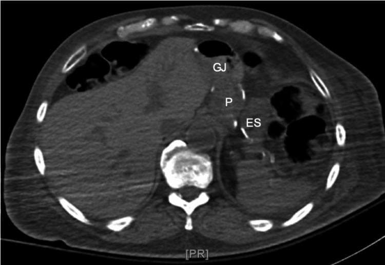 An axial computed tomography (CT) scan of the upper abdomen illustrating postoperative anatomy following Roux-en-Y gastric bypass (RYGB) surgery. The diagnostic image identifies three key gastrointestinal structures: the small gastric pouch (P), the excluded stomach (ES), and the gastrojejunal (GJ) anastomosis. The gastric pouch is visualized as a proximal, small-volume receptacle, separated laterally from the larger, defunctionalized excluded stomach (remnant stomach). The GJ anastomosis is located anteriorly, marking the surgical connection between the gastric pouch and the jejunal limb. Surrounding landmarks, including the liver, vertebrae, and ribs, provide anatomical orientation. This imaging is clinically relevant for evaluating postsurgical anatomy, identifying potential complications such as marginal ulcers or anastomotic leaks, and investigating metabolic symptoms like hyperinsulinemic hypoglycemia in bariatric patients.