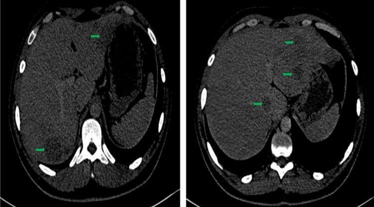This diagnostic image consists of two axial abdominal CT scan slices demonstrating hepatomegaly and diffuse liver involvement. The liver is significantly enlarged, with a measured hepatic span of approximately 17 cm. The parenchyma is characterized by multiple, scattered, hypodense tissue-like lesions (highlighted by green arrows). These lesions are rounded, well-circumscribed, and appear widespread across various hepatic segments, notably involving segment I (21 x 16mm) and segment V (36 x 27mm). Post-contrast administration, these nodules show no significant enhancement, maintaining a hypodense appearance relative to the surrounding normal hepatic tissue. The findings are indicative of an infiltrative or multifocal process, which clinically correlated with hepatic tuberculosis in this case. No deep lymphadenopathy is visible in these sections. The image serves as a clinical example of infectious granulomatous liver disease presenting as multiple hypodense nodules on computed tomography.