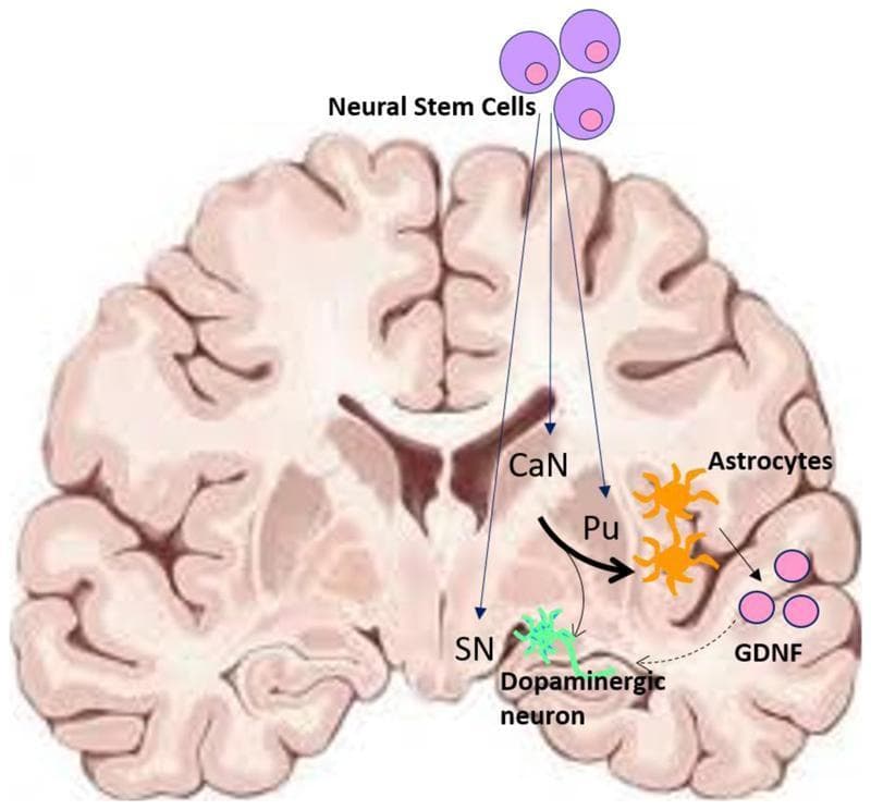 This medical illustration is a combined anatomical diagram and pathophysiology mechanism of action chart depicting the use of parthenogenetic neural stem cells (NSCs) in the treatment of Parkinson's Disease (PD). Superimposed on a coronal cross-section of a human brain, the diagram shows the targeted implantation sites for NSCs: the caudate nucleus (CaN), the putamen (Pu), and the substantia nigra (SN). The schematic illustrates the terminal differentiation of these implanted NSCs into two key cell types: orange-colored astrocytes located in the striatum and green-colored dopaminergic neurons near the substantia nigra. Solid arrows indicate conversion pathways, with varying thicknesses representing differentiation efficiencies. A dotted arrow signifies neurotrophic support, specifically the provision of glial cell line-derived neurotrophic factor (GDNF)—represented by purple circles—from the differentiated astrocytes to both intrinsic and grafted dopaminergic neurons. This visual summary highlights the dual therapeutic strategy of cell replacement and neurotrophic support within the nigrostriatal pathway to ameliorate the motor deficits associated with PD neurodegeneration.