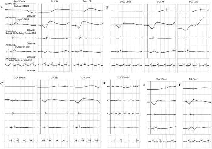 A multi-panel figure displaying diagnostic full-field electroretinography (ffERG) waveforms to evaluate retinal function. Panels A-D show results from four different patients with suspected retinal disorders, while Panels E and F provide normal controls. Each patient's panel (A, B, C) demonstrates traces at three dark adaptation (DA) intervals: 30 minutes, 3 hours, and 10 hours. The standard ISCEV protocol components shown include Scotopic 0.01 (rod response), Scotopic 3.0 (combined rod-cone response), Scotopic 3.0 Oscillatory Potentials, Photopic 3.0 (cone response), and 30Hz Flicker. The educational focus is on the delayed recovery of rod responses; at 30 minutes of DA, patients show nearly absent or severely attenuated scotopic b-waves compared to controls. After prolonged dark adaptation (3h and 10h), there is a significant progressive increase in b-wave amplitudes and normalization of waveform morphology, a characteristic finding in conditions like Fundus Albipunctatus (RDH5 mutations) or RPE65-related retinopathies.