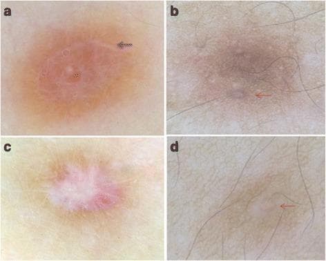 This composite diagnostic image displays four dermoscopic views (labeled a-d) of skin lesions, specifically common fibrous dermatofibromas (CFDF), showcasing atypical dermoscopic patterns. Frame 'a' demonstrates total homogeneous light-brown pigmentation with distinct white structures forming a ring-like configuration (indicated by a black arrow). Frames 'b' and 'd' show a peripheral pigment network that incorporates unusual white rings encircling follicular openings (indicated by red arrows), a pattern deviating from classic dermatofibroma presentation. Frame 'c' illustrates a discreet peripheral pigment network surrounding a central, star-shaped white patch. These images provide critical educational value for dermatology and oncology by documenting rare morphological variants of dermatofibromas, such as the white ring around follicles or total homogeneous patterns, which must be differentiated from other melanocytic and non-melanocytic skin tumors.