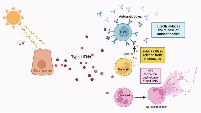This pathophysiology diagram illustrates the role of Type I Interferons (IFNs) in the pathogenesis of Systemic Lupus Erythematosus (SLE) triggered by ultraviolet (UV) radiation. The process begins with UV light stimulating a keratinocyte in the skin, which subsequently releases Type I IFNs (red circles). These interferons act as central mediators through three primary pathways: (1) Directly stimulating a B cell to release autoantibodies (Y-shaped blue structures); (2) Stimulating a monocyte to release B-lymphocyte stimulator (Blyss), which further promotes B cell autoantibody production; and (3) Stimulating a neutrophil to undergo NETosis. The NETosis pathway shows the transition of a normal neutrophil into a state of 'NET formation and release of self DNA,' where an extracellular web-like fiber network of nucleic acids is expelled. This network serves as a source of autoantigens, reinforcing the autoantibody response. The diagram highlights the transition from an innate immune response (keratinocytes, monocytes, and neutrophils) to an adaptive autoimmune response (B cells and autoantibodies) in a clinical context relevant to photosensitivity and SLE.