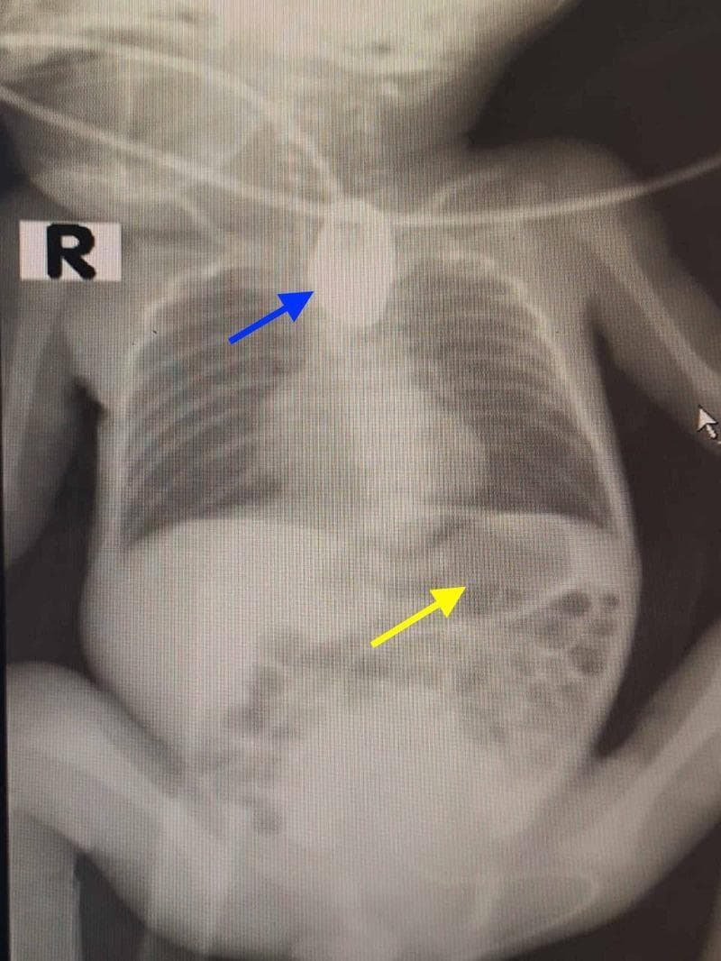This diagnostic radiograph of a neonate illustrates the classic findings of esophageal atresia (EA) with a distal tracheoesophageal fistula (TEF). The image displays a concentrated, radiopaque contrast-filled blind pouch in the superior mediastinum (indicated by the blue arrow), which demonstrates the termination of the proximal esophagus and confirms esophageal atresia. Simultaneously, the abdominal region shows significant gaseous distension within the stomach and intestinal loops (indicated by the yellow arrow). The presence of subdiaphragmatic gas in the setting of proximal esophageal atresia is pathognomonic for a distal tracheoesophageal fistula, which allows air to pass from the trachea into the distal digestive tract. This preoperative x-ray is essential for classifying the anatomical subtype of the congenital anomaly and planning surgical intervention. The skeletal structures, including the rib cage and vertebral column, serve as landmarks for the localization of the atretic segment relative to the thoracic inlet.