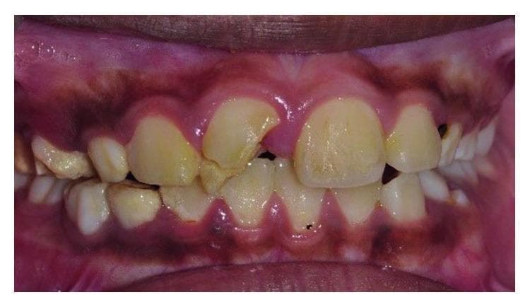 Frontal view intraoral clinical photograph showing the maxillary and mandibular anterior teeth. The primary pathology is a complicated crown-root fracture of the maxillary right central incisor (tooth 11). The fracture line is oblique, originating on the labial surface and extending palatally and subgingivally. A significant portion of the distal-incisal crown structure is missing, and the remaining coronal fragment appears slightly displaced. The surrounding gingival tissue at the site of injury shows signs of acute inflammation, including erythema and swelling, specifically in the interdental papilla area. The dentition exhibits generalized yellowish discoloration and extrinsic staining, with visible plaque accumulation along the gingival margins. The alignment of the maxillary and mandibular incisors is slightly irregular, characterized by minor crowding. The clinical presentation is consistent with traumatic dental injury requiring multidisciplinary management, including endodontic treatment, orthodontic extrusion, and restorative rehabilitation.