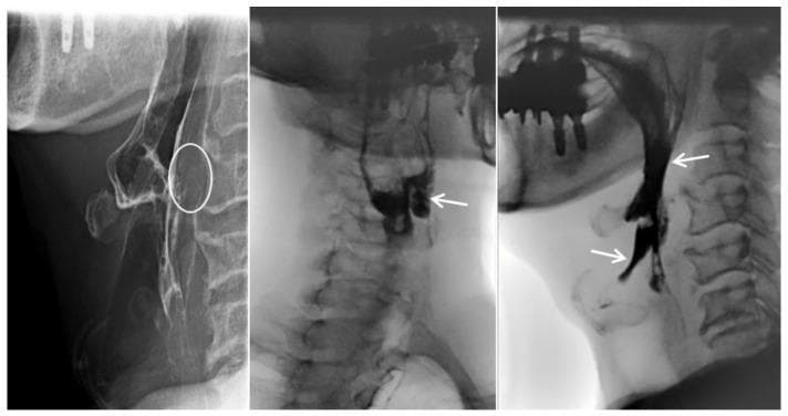 This diagnostic image consists of three lateral-view cervical esophagrams (fluoroscopic barium swallow study) demonstrating oropharyngeal dysphagia and mechanical obstruction. The first panel highlights prevertebral soft tissue swelling at the C3–C4 level (white circle), which causes extrinsic compression and anterior displacement of the esophagus. The subsequent panels illustrate functional swallowing impairment: radiopaque contrast material is seen abnormally pooling within the laryngeal vestibule and epiglottic space. White arrows indicate laryngeal penetration and aspiration, where contrast moves anteriorly into the airway rather than proceeding through the upper esophageal sphincter. These findings are clinically significant for diagnosing mechanical dysphagia, in this case secondary to an anteriorly extruded cervical disc. Key educational concepts include the radiographic identification of aspiration, the assessment of prevertebral soft tissue thickness, and the recognition of extrinsic esophageal compression in the context of cervical spine pathology.