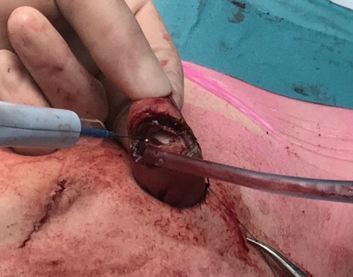 This clinical photograph captures an intraoperative view of a surgical stoma creation (ileostomy or colostomy). The image focuses on the exteriorization and incision of a bowel segment through the abdominal wall. The protruding bowel is reddish-brown and moist, showing a visible staple line from a previous transection. A surgeon's gloved hand stabilizes the tissue while an electrocautery device with a blue cable is used to perform a precision incision at the tip of the exteriorized segment. A clear catheter or suction tube is inserted into the lumen of the bowel to manage contents during the procedure. The surrounding peristomal skin shows signs of surgical preparation, including mild erythema and surgical sutures. A surgical instrument, likely forceps, is visible in the lower right field, assisting in tissue manipulation. This visual illustrates a critical step in stoma maturation, specifically the opening of the bowel wall before full-thickness eversion and fixation to the skin to create a functional spout.