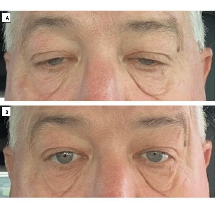 This clinical photograph consists of a side-by-side comparison (labeled A and B) demonstrating the pharmacological management of bilateral eyelid ptosis in a patient with Myasthenia Gravis (MG).
Panel A (Baseline): Displays severe bilateral upper eyelid drooping, which obscures approximately 30-40% of the superior iris and limits the palpebral fissure width. The periorbital skin shows significant laxity and skin folds characteristic of chronic ptosis and aged skin.
Panel B (Post-Treatment): Shows the same patient 30 minutes after the administration of oxymetazoline hydrochloride 0.1% ophthalmic solution. There is a notable elevation of both upper eyelids, resulting in increased exposure of the iris and sclera, with only 5-10% of the iris remaining covered.
Educational Focus: The images illustrate the clinical efficacy of alpha-adrenergic agonists in stimulating Mรผllerโs muscle (sympathetic smooth muscle) to improve eyelid elevation. This comparison highlights a non-surgical management option for symptomatic ptosis in patients with neuromuscular junction disorders or refractory weakness.