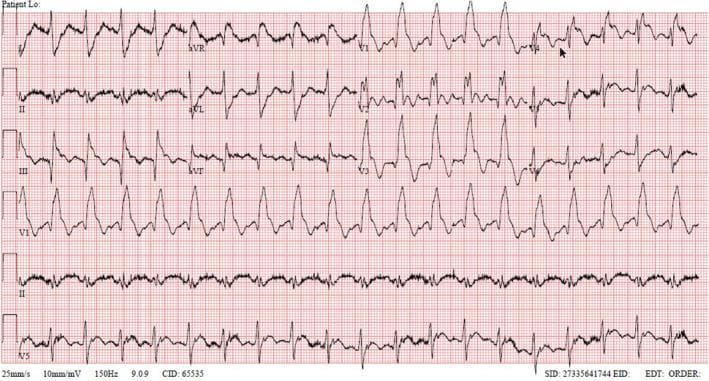 This diagnostic image is a 12-lead electrocardiogram (ECG) demonstrating a severe acute ST-segment elevation myocardial infarction (STEMI) pattern. The tracing shows sinus tachycardia with a right bundle branch block (RBBB) morphology. Key pathological features include a prominent 'shark fin' pattern (monophasic QRS-ST-T complex) in the anterior leads V1 through V4, characterized by massive ST-segment elevation that merges directly with the T-wave. Significant ST-segment elevation is also visible in lead aVR and the inferior leads (III and aVF). These findings are highly specific for extensive myocardial ischemia, often associated with proximal left anterior descending (LAD) artery occlusion or multi-vessel disease. The educational focus of this image is the recognition of high-risk ECG signatures, such as the shark fin morphology and aVR elevation, which indicate critical hemodynamic instability and the need for immediate reperfusion therapy. The tracing also displays baseline artifact consistent with patient distress or clinical urgency.
