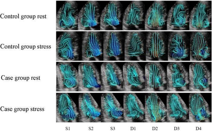 This diagnostic image represents a comparative analysis of left ventricular (LV) hemodynamics using vector flow mapping (VFM) technology. The visual presents a 4x7 grid comparing four cohorts: 'Control group rest', 'Control group stress', 'Case group rest', and 'Case group stress' across seven phases of the cardiac cycle: isovolumetric contraction (S1), rapid ejection (S2), slow ejection (S3), isovolumetric relaxation (D1), rapid filling (D2), slow filling (D3), and atrial systole (D4). Blue streamlines visualize the intracardiac blood flow patterns and vortex formation. Key educational features include the visualization of normal vortex formation at the basal segment during S1 and D4 in the control group, and the alteration of these patterns under pharmacological or exercise stress. The comparison highlights variations in streamline density, directionality, and organization between healthy controls and cases (potentially coronary artery disease or heart failure), specifically noting the more disordered streamlines and reduced apical flow density in the case groups during rapid filling (D2) and isovolumetric relaxation (D1). This imaging modality is used to evaluate cardiac efficiency and diastolic function through vortex area and circulation parameters.