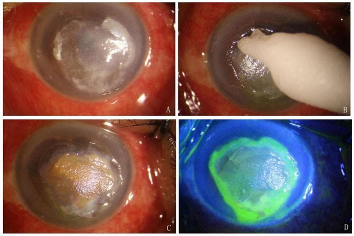 Clinical Slit-lamp Photograph (four panels) illustrating the procedure of Local Application of Silver Nitrate (LASN) for a corneal ulcer. Panel A shows a debrided corneal ulcer appearing as a central whitish, opaque lesion with irregular margins on a congested eye. Panel B demonstrates the application phase, with a silver nitrate cotton stick making contact with the corneal surface. Panel C displays the immediate post-treatment outcome, where the ulcer bed has developed a characteristic brown-to-yellowish precipitate due to the silver nitrate reaction. Panel D shows fluorescein sodium staining under cobalt blue light; intense green fluorescence is localized to the ulcerated area, demarcating the epithelial defect, while the surrounding healthy cornea and conjunctiva remain negative for staining. This sequence illustrates a chemical debridement technique often used in the management of infectious or refractory corneal ulcers to reduce microbial load and promote healing.