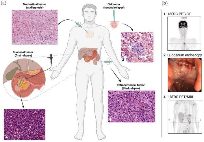 This composite educational infographic illustrates the diagnostic workup and progression of extramedullary manifestations (EM) of Acute Myeloid Leukemia (AML) in a 25-year-old patient. Panel (a) contains a central anatomical diagram showing the chronicity and location of four EM sites: (1) mediastinum, (2) duodenum, (3) skin (chloroma), and (4) retroperitoneum. Arrows point to corresponding hematoxylin and eosin (H&E) stained histopathology images for each site, demonstrating myeloid blasts and varying cellular density. The mediastinal and retroperitoneal tumors are shown being sampled via CT-guided biopsy, the duodenal tumor via endoscopy, and the chloroma via punch biopsy. Panel (b) provides diagnostic imaging correlation: (b1) 18FDG-PET/CT showing a hypermetabolic mediastinal mass, (b2) a duodenoscopy photograph revealing a friable, obstructive mass, and (b4) an 18FDG-PET/MRI depicting retroperitoneal disease. The visual summarizes the complex clinical course of multi-site extramedullary relapse despite bone marrow remission, emphasizing the role of integrated imaging and histological confirmation in AML management.