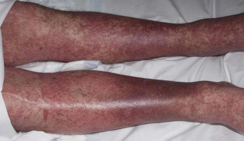 Clinical photograph of a patient's lower extremities demonstrating a widespread, symmetrical erythematous papular rash. The eruption is characterized by numerous small, reddish, raised lesions (papules) that are densely distributed across the anterior and lateral surfaces of both legs, extending from the thighs down to the ankles. In several regions, particularly over the shins and calves, the lesions show a tendency toward confluence, forming larger erythematous patches. The background skin exhibits generalized erythema without evidence of vesiculation, bullae, or overt necrosis. This morbilliform (measles-like) presentation is clinically significant in dermatology as a common manifestation of systemic drug eruptions, such as Drug Reaction with Eosinophilia and Systemic Symptoms (DRESS) syndrome. The image illustrates the classic cutaneous morphology of a hypersensitivity reaction, where the density and distribution of the maculopapular rash are key diagnostic features for evaluating adverse drug reactions and differentiating from other inflammatory or infectious dermatoses.